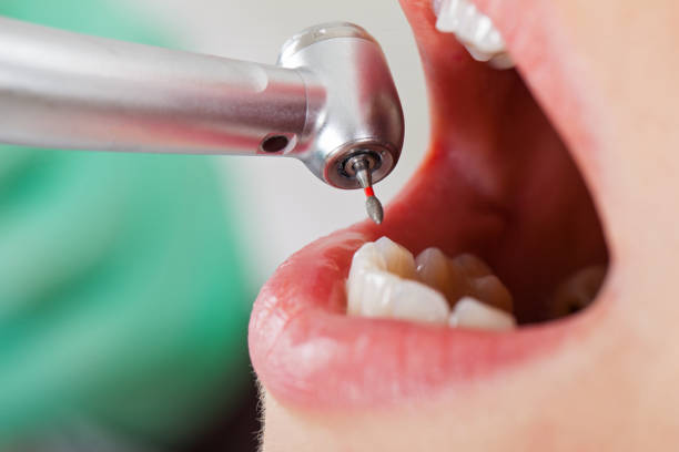 Best Emergency Wisdom Tooth Extraction in Perry, IA
